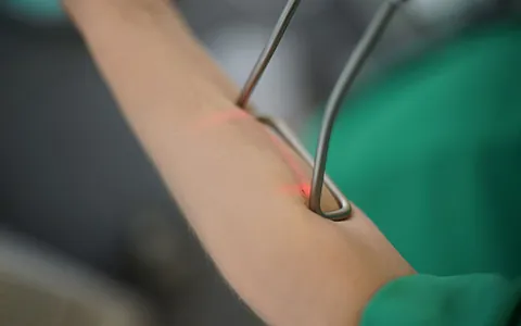 Haarentfernung mitels Laser